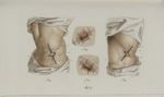 Pl. 69. Opération de l'anus artificiel. Procédés opératoires - Précis iconographique de médecine opé [...]