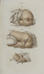 Pl. 71. Suite des opérations qui se pratiquent sur l'anus et le rectum. Tumeurs hémorrhoïdales - Pré [...]
