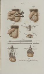 Pl. 74. Opération du varicocèle - Précis iconographique de médecine opératoire et d'anatomie chirurg [...]