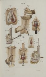 Pl. 79. Anatomie chirurgicale du périnée. - Tailles périnéales et rectale inférieure - Précis iconog [...]