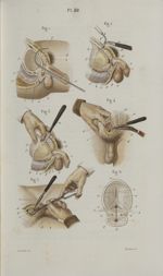 Pl. 80. Taille sus-pubienne ou hypogastrique - Précis iconographique de médecine opératoire et d'ana [...]