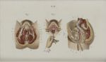 Pl. 81. Opérations qui se pratiquent sur les organes génitaux de la femme - Précis iconographique de [...]