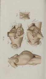 Opération césarienne. - Symphyséotomie - Précis iconographique de médecine opératoire et d'anatomie  [...]