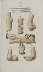 Pl. 88. Pieds-bots. - Section du tendon d'Achille - Précis iconographique de médecine opératoire et  [...]