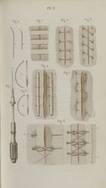 Pl. 2. Réunions. Fig. 2,3,4,5,6. Sutures - Précis iconographique de médecine opératoire et d'anatomi [...]