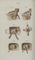 Pl. 40. - Opérations qui se pratiquent sur les muscles de l'œil - Précis iconographique de médecine  [...]