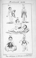 Planche XVIII. Monstruosités. Fig. 1. Hétéropage / Fig. 2 et 3. Hétérodyme / Fig. 4 à 6. Hétéradelph [...]