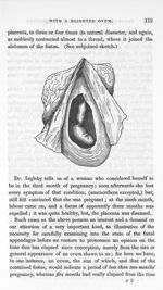 [The foetus seemed perfectly healthy, but very small] - An exposition of the signs and symptoms of p [...]