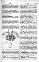 Fig. 230. [Iridectomie] - Dictionnaire de médecine, de chirurgie, de pharmacie, des sciences accesso [...]