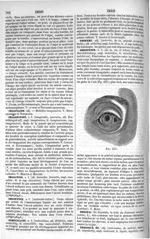 Fig. 237. [Imbibition cadavérique du globe de l'oeil] - Dictionnaire de médecine, de chirurgie, de p [...]