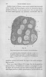 Fig. 20. Foyer hémorrhagique dans un ganglion - Leçons sur les maladies de la peau / vol. 1