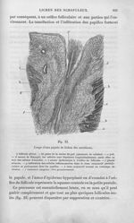 Fig. 22. Coupe d'une papule de lichen des scrofuleux - Leçons sur les maladies de la peau / vol. 1