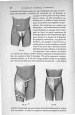 Fig. 16, 17, 18 - Traité de médecine opératoire, bandages et appareils. 4è éd. Tome second