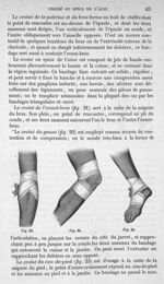 Fig. 23, 24, 25 - Traité de médecine opératoire, bandages et appareils. 4è éd. Tome second
