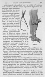 Fig. 33, 34 - Traité de médecine opératoire, bandages et appareils. 4è éd. Tome second