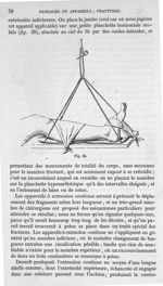 Fig. 35 - Traité de médecine opératoire, bandages et appareils. 4è éd. Tome second