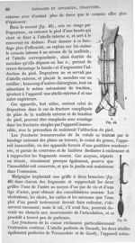 Fig. 45, 46 - Traité de médecine opératoire, bandages et appareils. 4è éd. Tome second