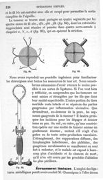 Fig. 84, 85, 86 - Traité de médecine opératoire, bandages et appareils. 4è éd. Tome second