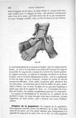 Fig. 111 - Traité de médecine opératoire, bandages et appareils. 4è éd. Tome second