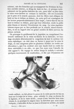 Fig. 112 - Traité de médecine opératoire, bandages et appareils. 4è éd. Tome second