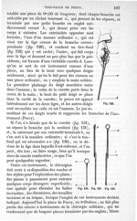 Fig. 129 à Fig. 132 - Traité de médecine opératoire, bandages et appareils. 4è éd. Tome second
