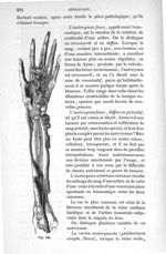 Fig. 136 - Traité de médecine opératoire, bandages et appareils. 4è éd. Tome second