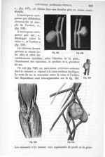 Fig. 137 à Fig. 141 - Traité de médecine opératoire, bandages et appareils. 4è éd. Tome second