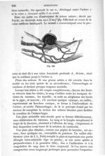 Fig. 142 - Traité de médecine opératoire, bandages et appareils. 4è éd. Tome second