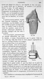 Fig. 143, 144 - Traité de médecine opératoire, bandages et appareils. 4è éd. Tome second