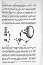 Fig. 145, 146 - Traité de médecine opératoire, bandages et appareils. 4è éd. Tome second