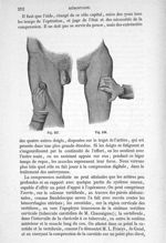 Fig. 147, 148 - Traité de médecine opératoire, bandages et appareils. 4è éd. Tome second