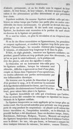 Fig. 150., Fig. 151 - Traité de médecine opératoire, bandages et appareils. 4è éd. Tome second