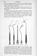 Fig. 155. à Fig. 159 - Traité de médecine opératoire, bandages et appareils. 4è éd. Tome second