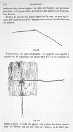 Fig. 171., Fig. 172 - Traité de médecine opératoire, bandages et appareils. 4è éd. Tome second