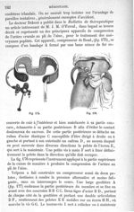 Fig. 175., Fig. 176 - Traité de médecine opératoire, bandages et appareils. 4è éd. Tome second