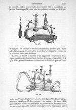 Fig. 177., Fig. 178 - Traité de médecine opératoire, bandages et appareils. 4è éd. Tome second