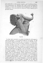 Fig. 187 - Traité de médecine opératoire, bandages et appareils. 4è éd. Tome second