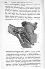 Fig. 192 - Traité de médecine opératoire, bandages et appareils. 4è éd. Tome second