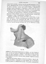 Fig. 193 - Traité de médecine opératoire, bandages et appareils. 4è éd. Tome second