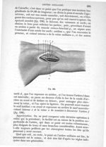 Fig. 196 - Traité de médecine opératoire, bandages et appareils. 4è éd. Tome second