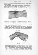 Fig. 200., Fig. 201 - Traité de médecine opératoire, bandages et appareils. 4è éd. Tome second