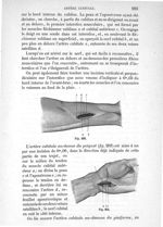 Fig. 203., Fig. 204 - Traité de médecine opératoire, bandages et appareils. 4è éd. Tome second