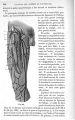 Fig. 208 - Traité de médecine opératoire, bandages et appareils. 4è éd. Tome second