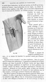 Fig. 210 - Traité de médecine opératoire, bandages et appareils. 4è éd. Tome second