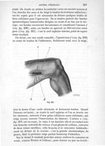Fig. 211 - Traité de médecine opératoire, bandages et appareils. 4è éd. Tome second
