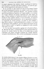 Fig. 213 - Traité de médecine opératoire, bandages et appareils. 4è éd. Tome second