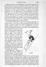 Fig. 223 - Traité de médecine opératoire, bandages et appareils. 4è éd. Tome second