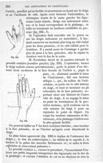 Fig. 234., Fig. 235 - Traité de médecine opératoire, bandages et appareils. 4è éd. Tome second