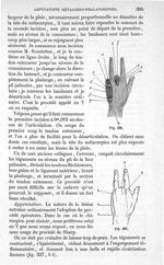 Fig. 236., Fig. 237 - Traité de médecine opératoire, bandages et appareils. 4è éd. Tome second