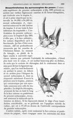 Fig. 239., Fig. 240 - Traité de médecine opératoire, bandages et appareils. 4è éd. Tome second